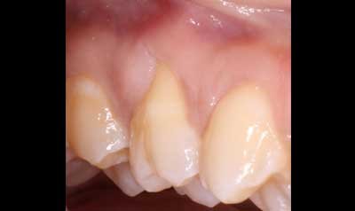 Recession & Root Coverage case 89 — before