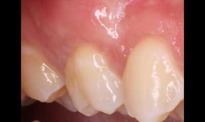 Recession & Root Coverage case 89 — after