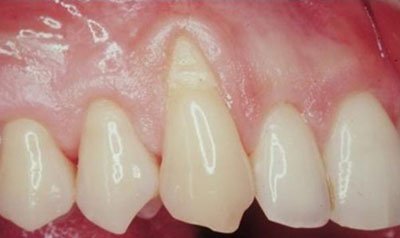 Recession & Root Coverage case 8 — before