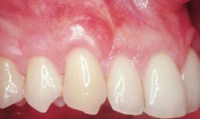 Recession & Root Coverage case 8 — after