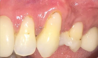 Recession & Root Coverage case 10 — before