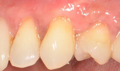 Recession & Root Coverage case 10 — after