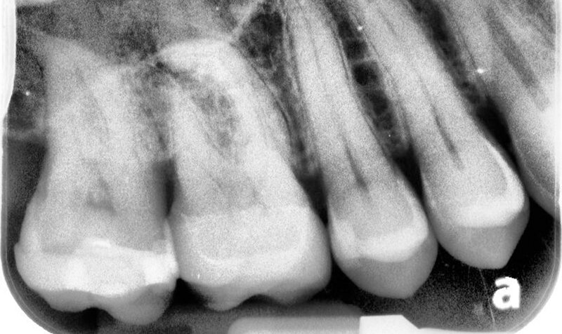 Root Canal Cases case 152 — before