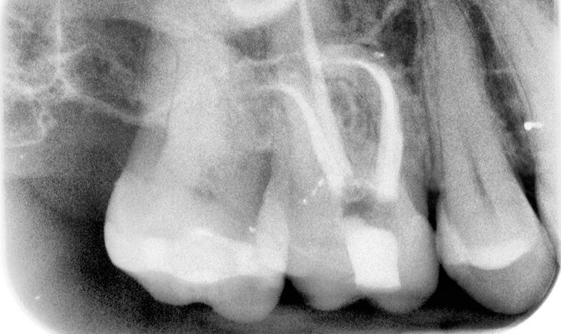 Root Canal Cases case 152 — after
