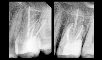 Root Canal Cases case 30 — before