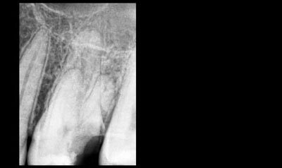 Root Canal Cases