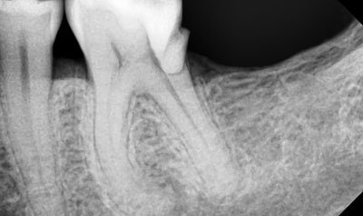 Root Canal Cases case 32 — before