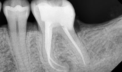 Root Canal Cases case 32 — after