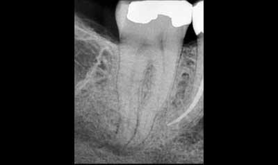 Root Canal Cases case 44 — before
