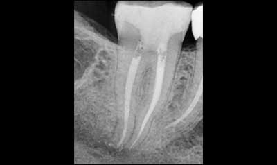 Root Canal Cases case 44 — after