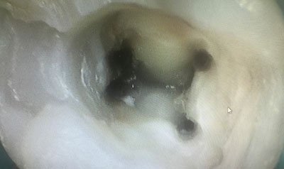 Root Canal Cases case 52 — before