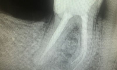 Root Canal Cases case 52 — after