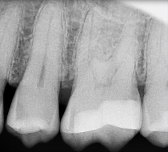 Root Canal Cases case 61 — before