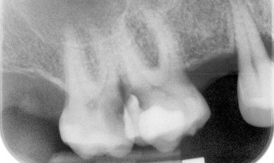 Root Canal Cases case 72 — before