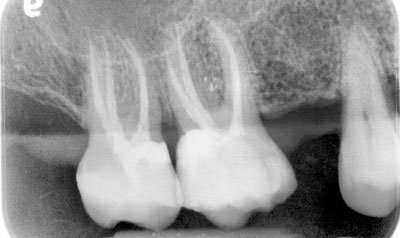 Root Canal Cases case 72 — after