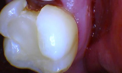 Root Canal Cases case 73 — before