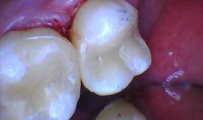 Root Canal Cases case 73 — after