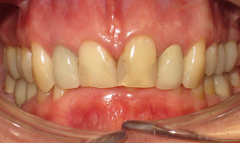 Same Day Crown — CEREC Cases case 166 — before