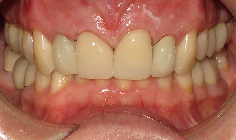 Same Day Crown — CEREC Cases case 166 — after
