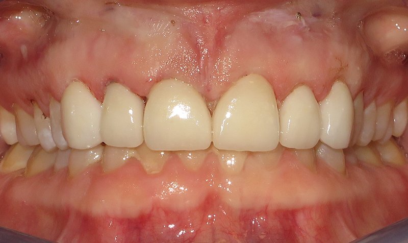 Same Day Crown — CEREC Cases case 167 — before