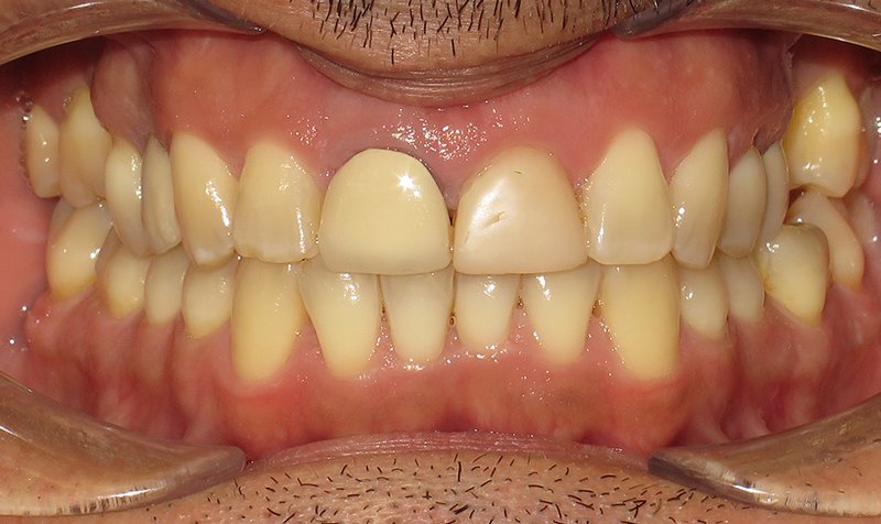 Same Day Crown — CEREC Cases case 171 — before