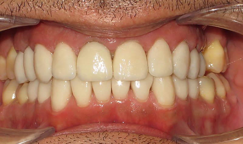 Same Day Crown — CEREC Cases case 171 — after