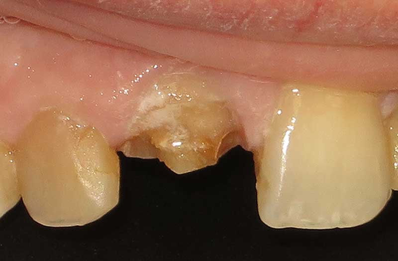 Same Day Crown — CEREC Cases case 176 — before
