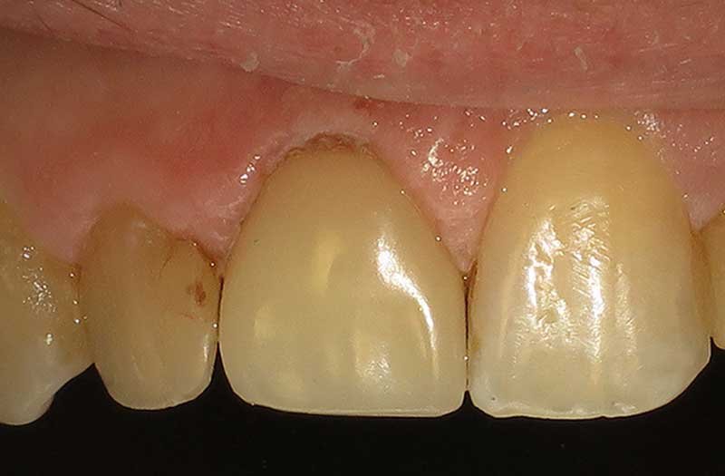 Same Day Crown — CEREC Cases case 176 — after