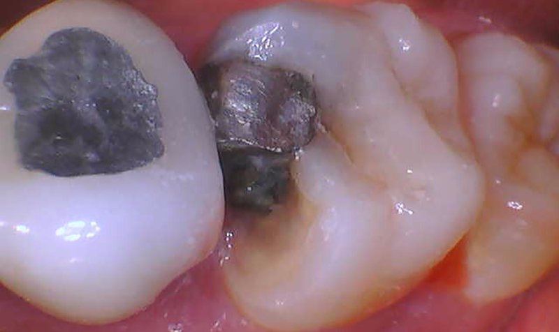 Same Day Crown — CEREC Cases case 195 — before
