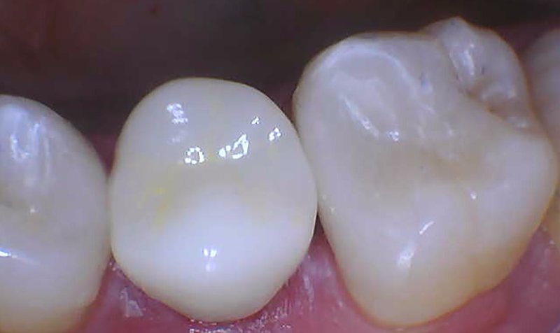 Same Day Crown — CEREC Cases case 195 — after
