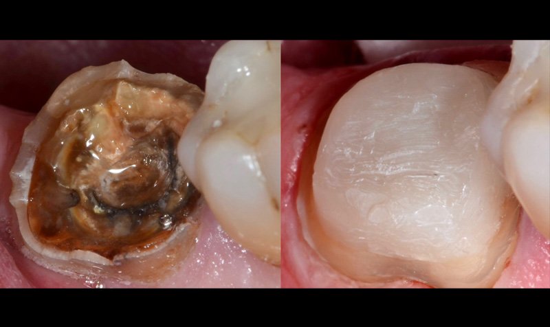 Same Day Crown — CEREC Cases case 197 — before