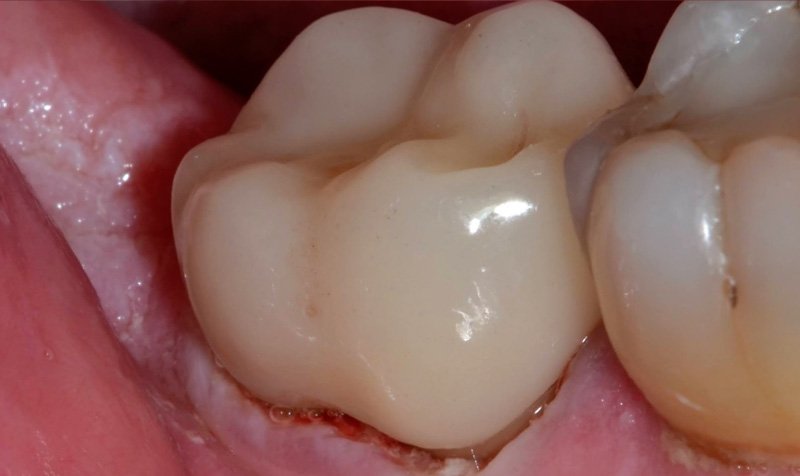Same Day Crown — CEREC Cases case 197 — after