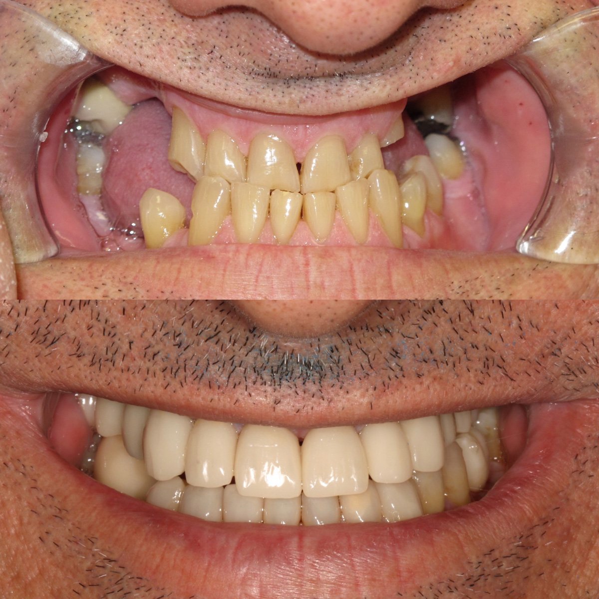 Same Day Crown — CEREC Cases case 200 — before