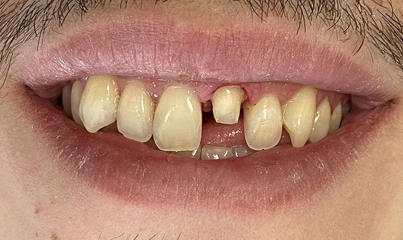 Same Day Crown — CEREC Cases case 211 — before