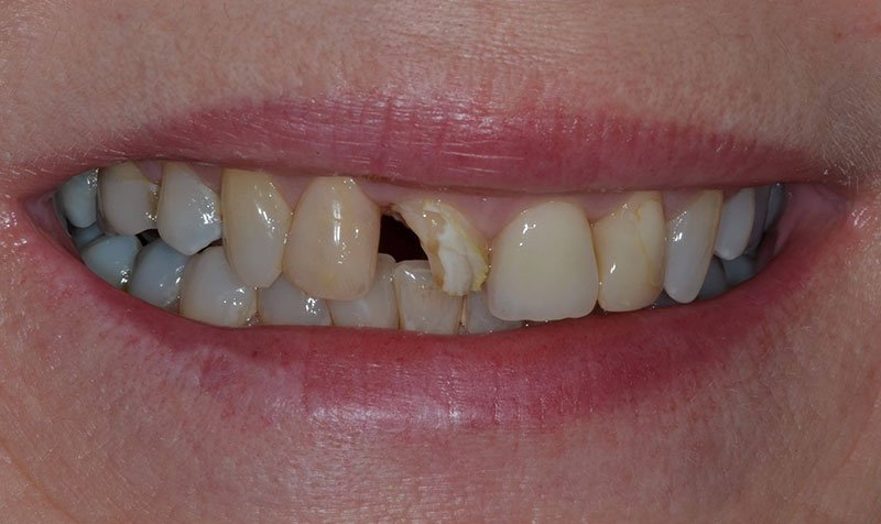 Same Day Crown — CEREC Cases case 212 — before