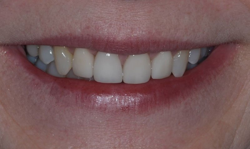 Same Day Crown — CEREC Cases case 212 — after