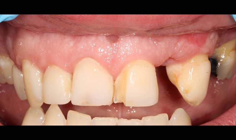 Same Day Crown — CEREC Cases case 214 — before