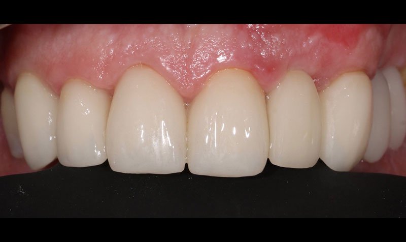 Same Day Crown — CEREC Cases case 214 — after