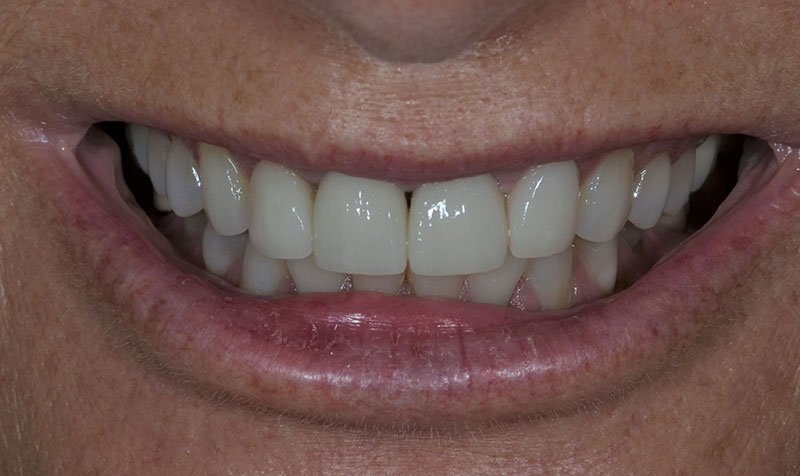 Same Day Crown — CEREC Cases case 215 — before