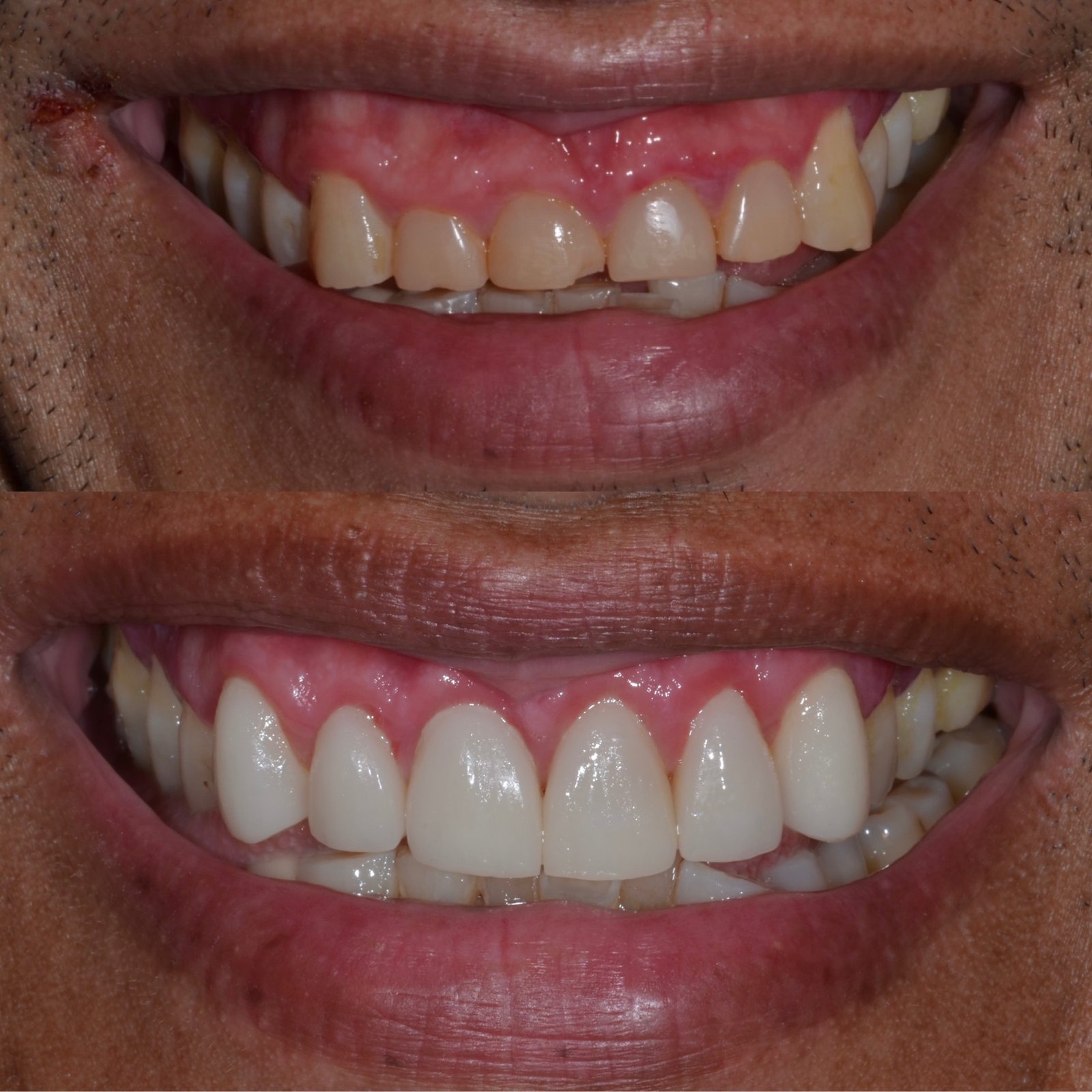 Same Day Crown — CEREC Cases case 216 — before