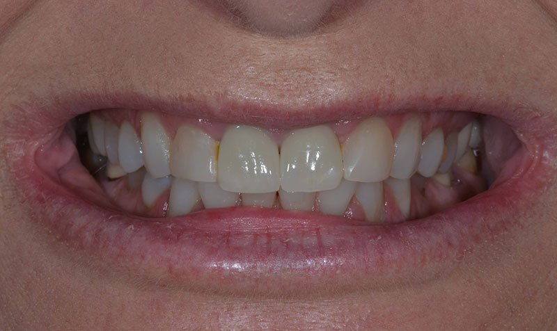 Same Day Crown — CEREC Cases case 217 — before