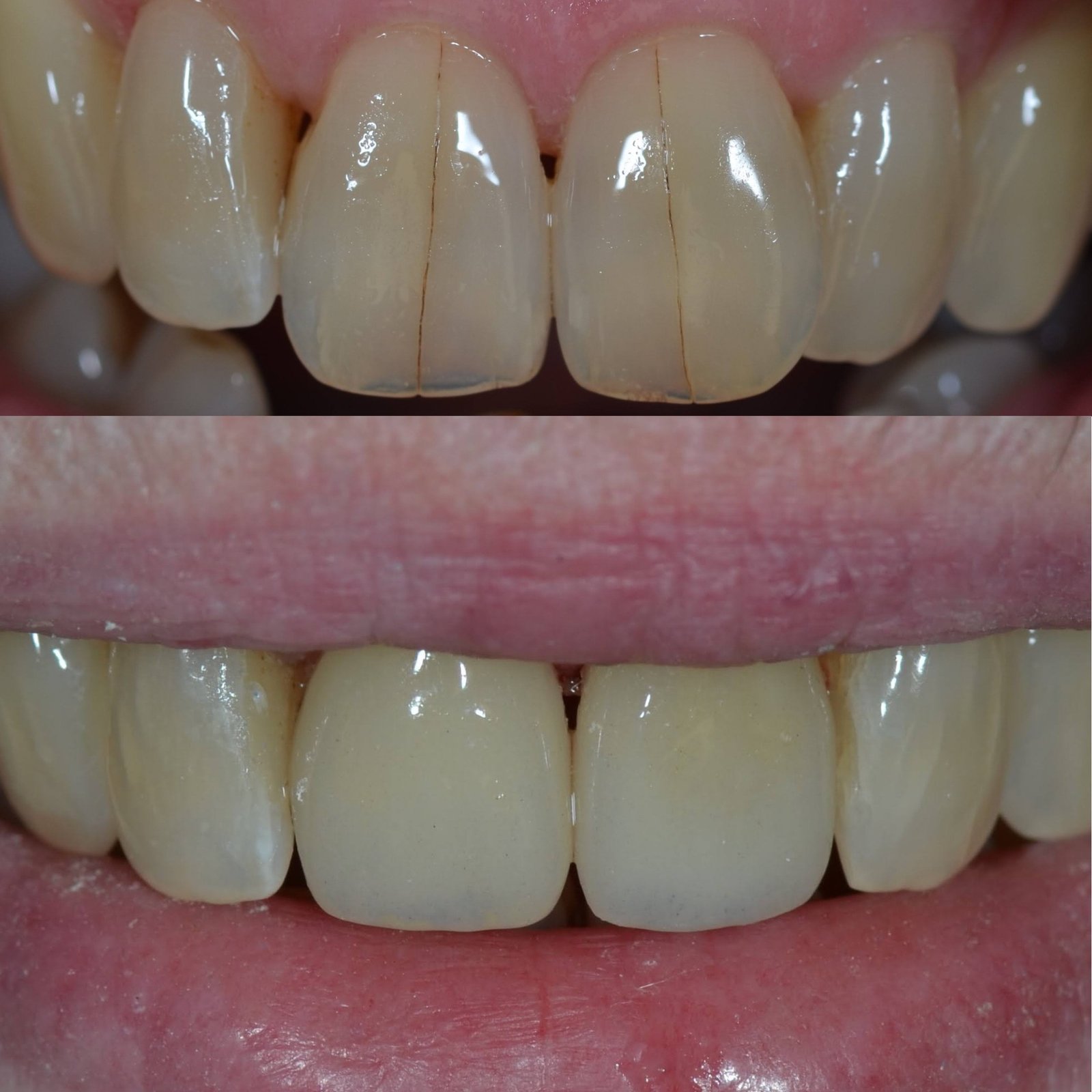 Same Day Crown — CEREC Cases case 218 — before
