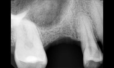 Sinus Lift Cases case 101 — before