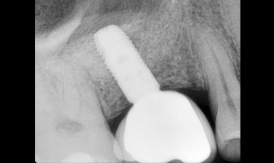Sinus Lift Cases case 101 — after