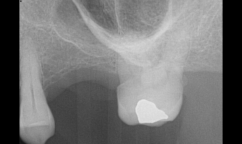 Sinus Lift Cases case 210 — before