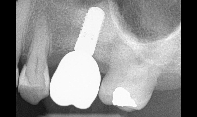Sinus Lift Cases case 210 — after