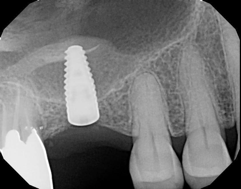 Sinus Lift Cases case 213 — before