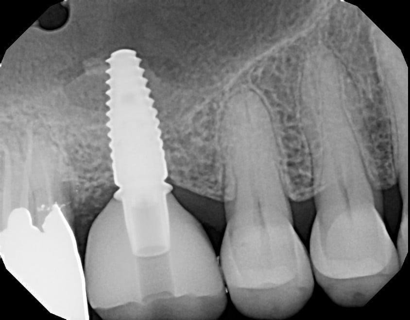 Sinus Lift Cases case 213 — after