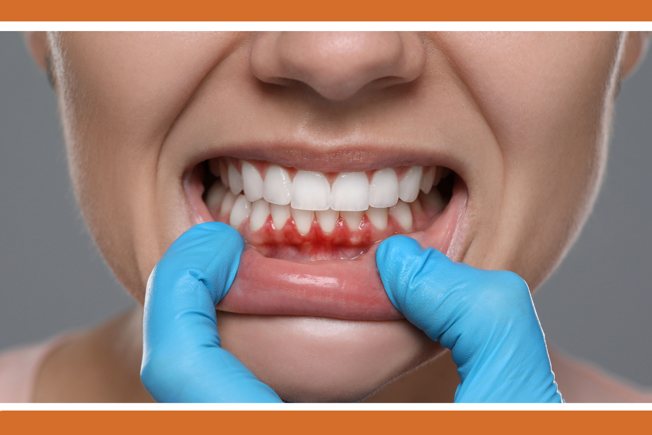 Gum disease Hamilton, dentist examining a patient's inflamed and bleeding gums during a periodontal evaluation.