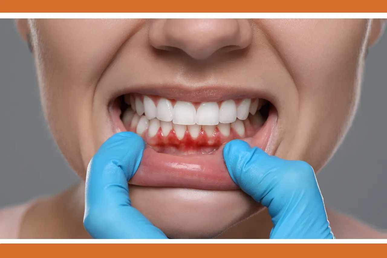 Gum Disease and Receding Gums: Understanding the Risks and Solutions Gum Disease and Receding Gums: Understanding the Risks and Solutions